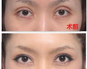 深圳双眼皮修复哪位医生比较好?深圳双眼皮修复专家排行榜