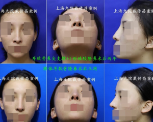 上海九院谁做鼻修复好？上海九院隆鼻修复预约最多的专家排行榜