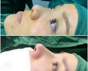 刘彦军、李劲良、王会勇哪个做鼻子修复最好？刘彦军、李劲良、王会勇隆鼻修复案例对比在线预约