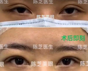 广州眼修复专家哪个最好？陈芝、潘贰、黄泽春、曾繁茂、李光琴谁做双眼皮修复技术口碑反馈好？