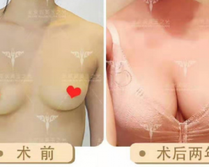 北京自体脂肪隆胸最好的医生有哪些？北京隆胸预约最多的专家排行榜大全