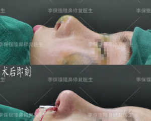 杭州鼻子修复最好的医生是谁？杭州鼻子修复最好的专家有哪些？
