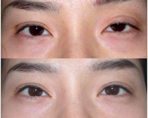 杜园园和刘志刚两位专家哪位擅长眼角？杜园园和刘志刚谁做眼角的技术更好呢？