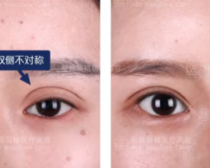 中国双眼皮修复专家排名 中国预约最多的双眼皮修复医生预约排名