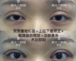 郑州修复双眼皮最好的医生是哪个？郑州双眼皮修复专家预约排名大全